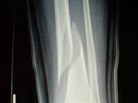 You Failed-broken-leg-pics-005.jpg